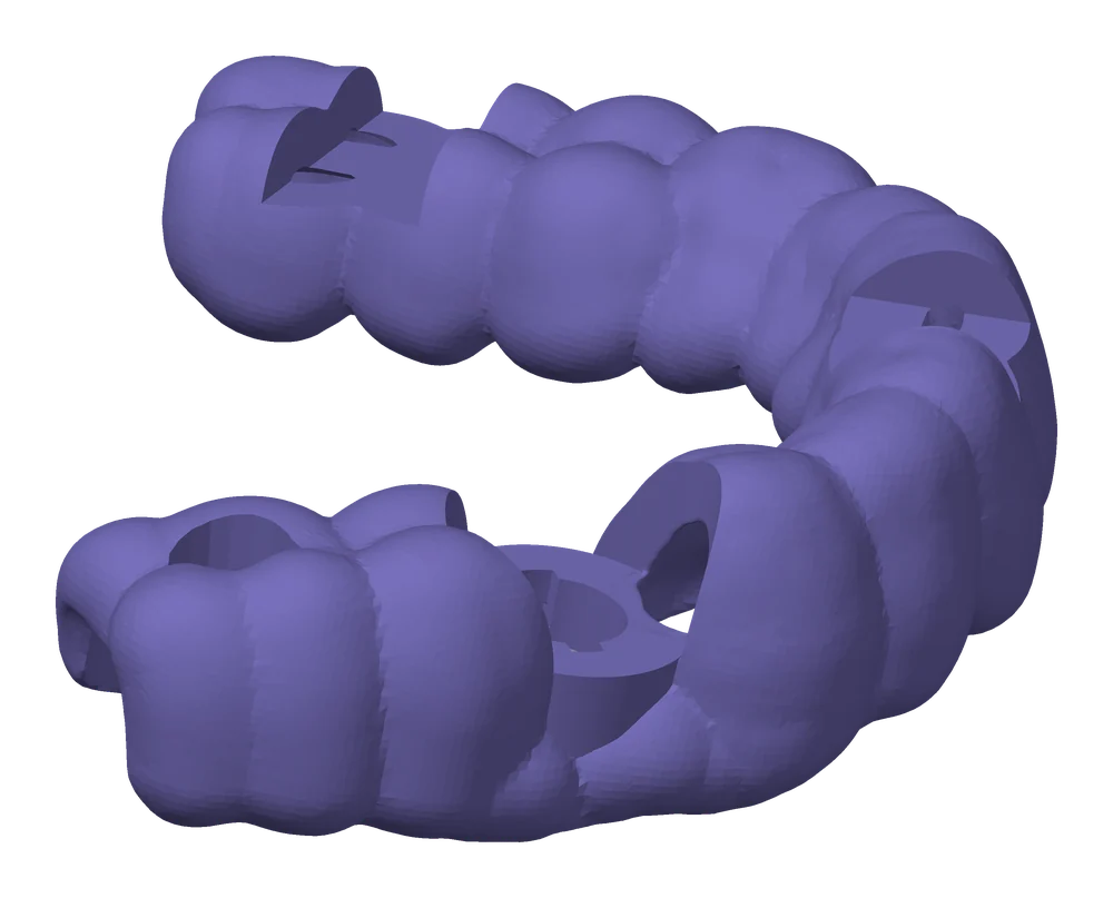Surgical guide printed from a real case: arch-contoured KeyGuide resin with the titanium sleeve seated in its barrel