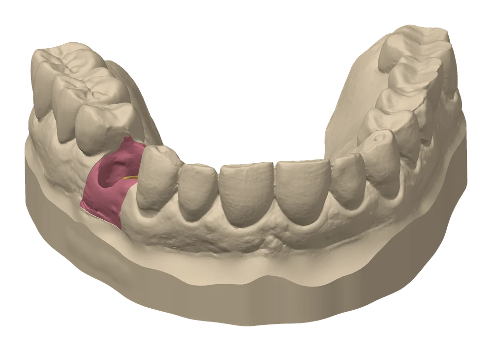 Printed model of an actual case arch in cream resin, with the pink gingiva mask and gold analog seated at the implant site